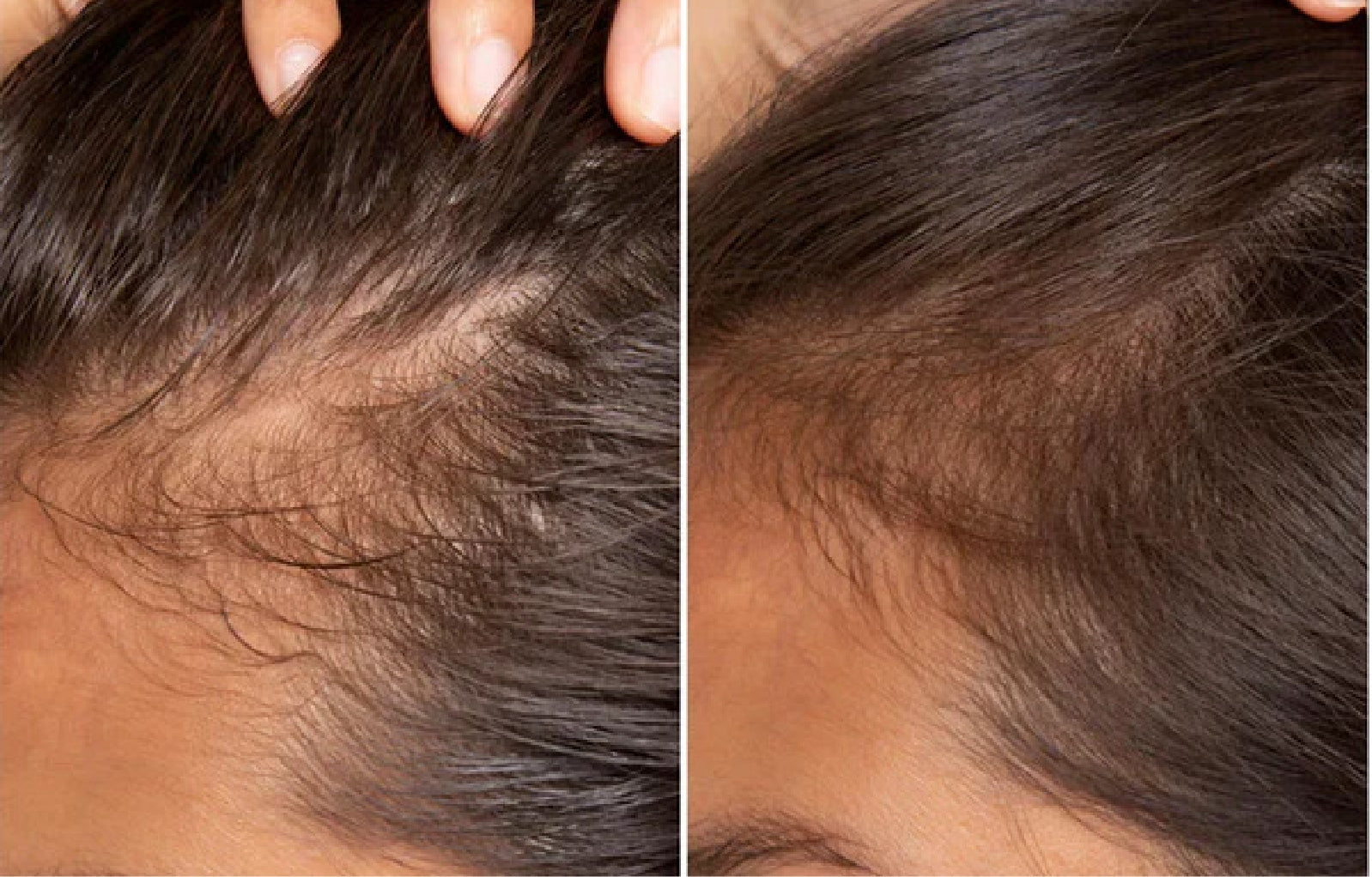 Línea del cabello con entradas marcadas y la misma zona con aspecto más poblado tras el uso continuo